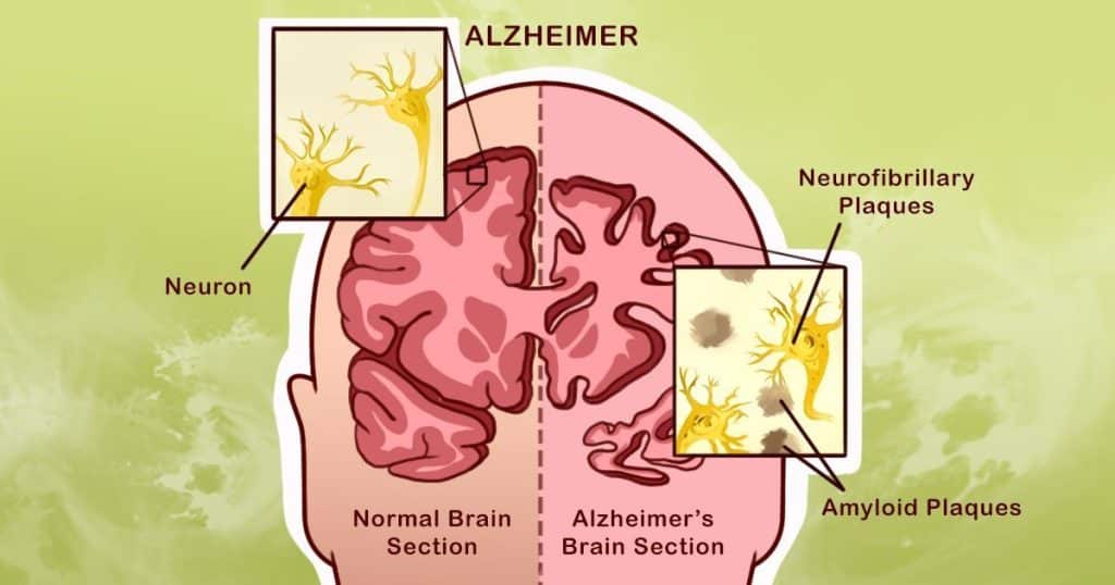Alzheimer's disease, Knowing Alzheimer's disease, What is Alzheimer's disease,